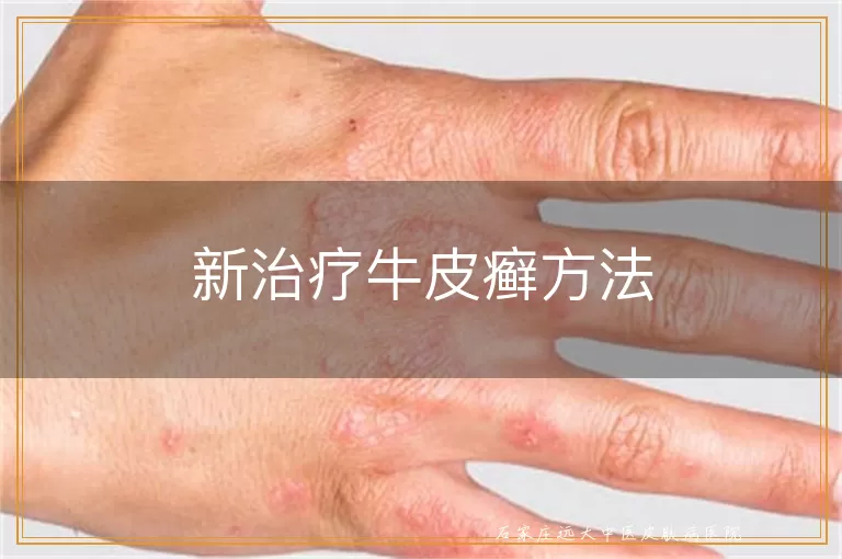 新治疗牛皮癣方法