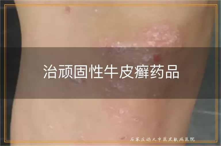 治顽固性牛皮癣药品