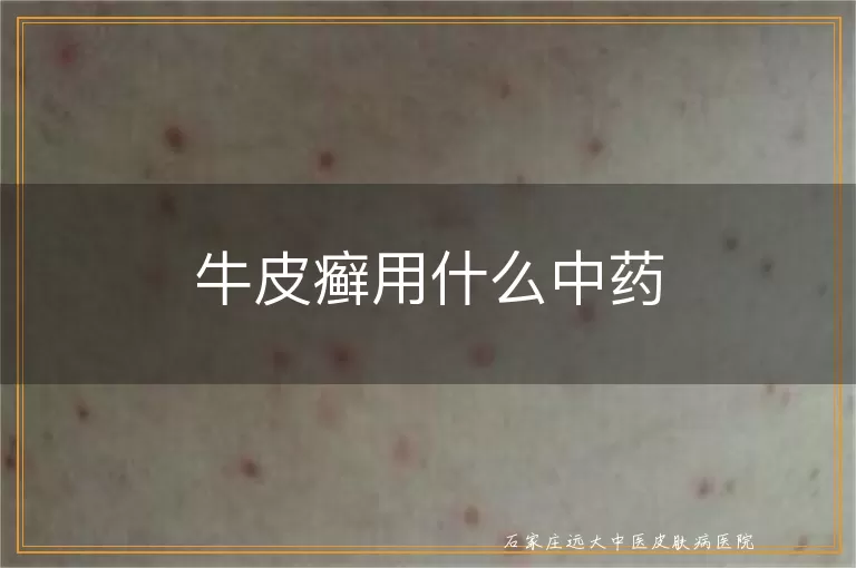 牛皮癣用什么中药
