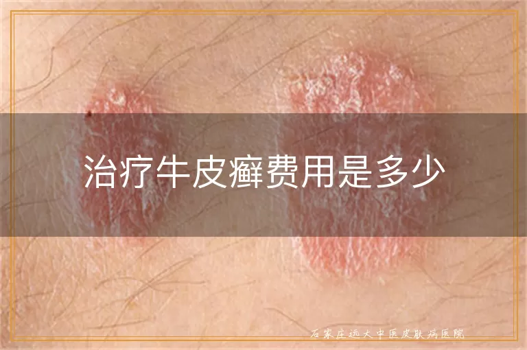 治疗牛皮癣费用是多少