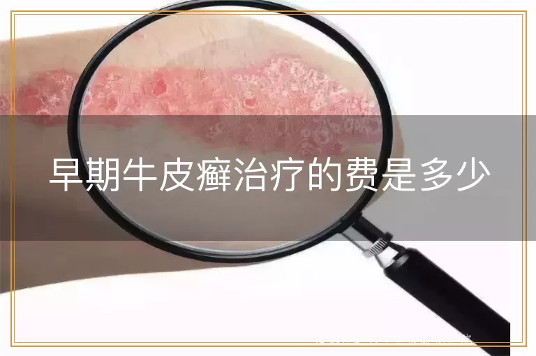 早期牛皮癣治疗的费是多少