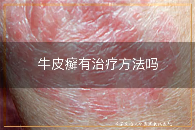 牛皮癣有治疗方法吗