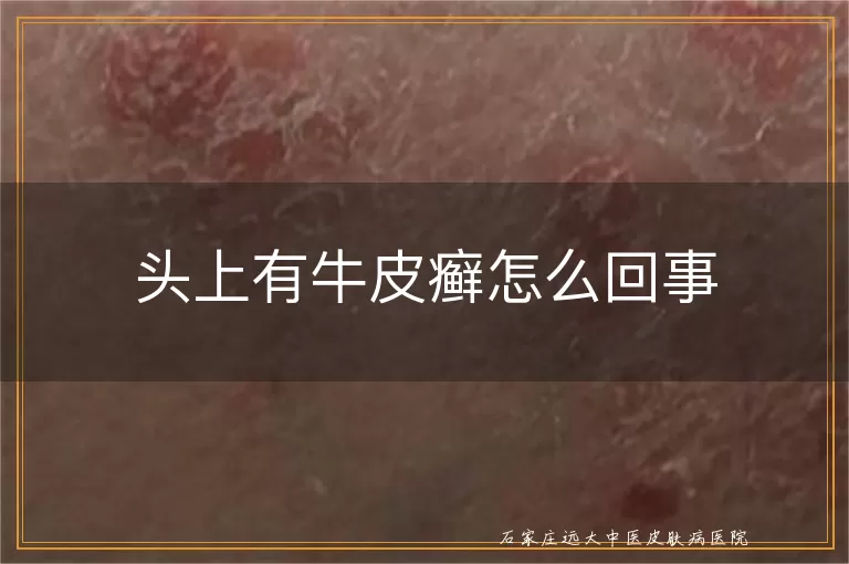 头上有牛皮癣怎么回事