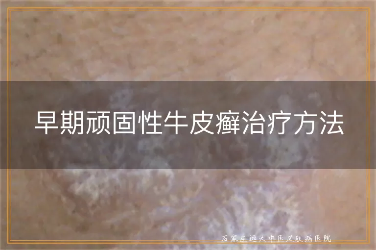早期顽固性牛皮癣治疗方法