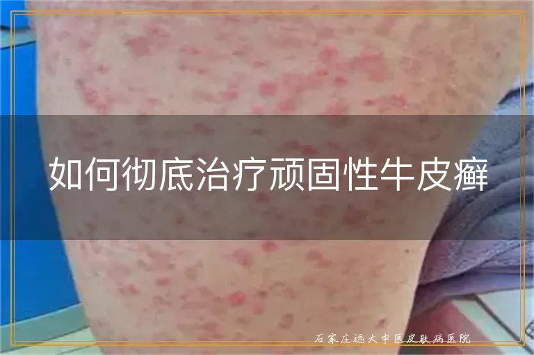 如何彻底治疗顽固性牛皮癣