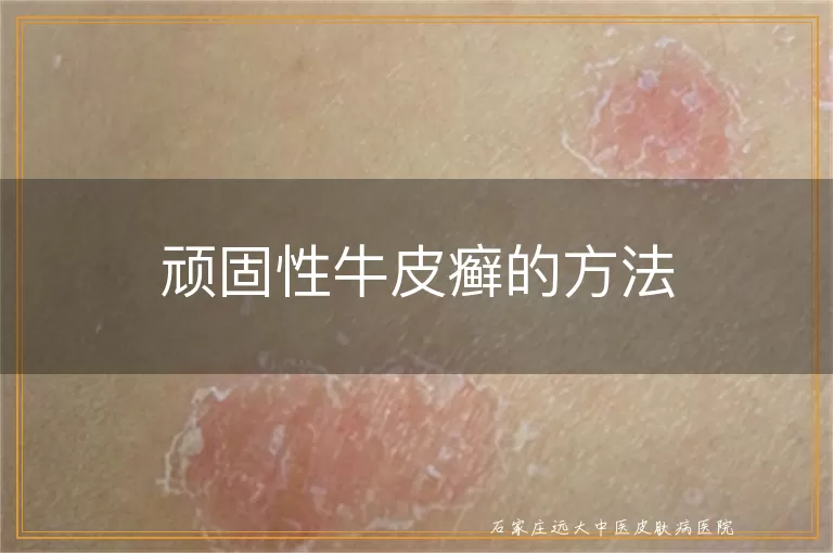 顽固性牛皮癣的方法