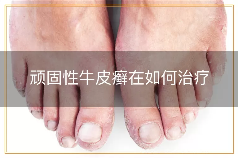 顽固性牛皮癣在如何治疗