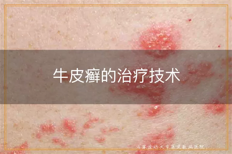 牛皮癣的治疗技术