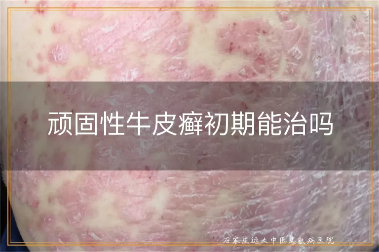 顽固性牛皮癣初期能治吗