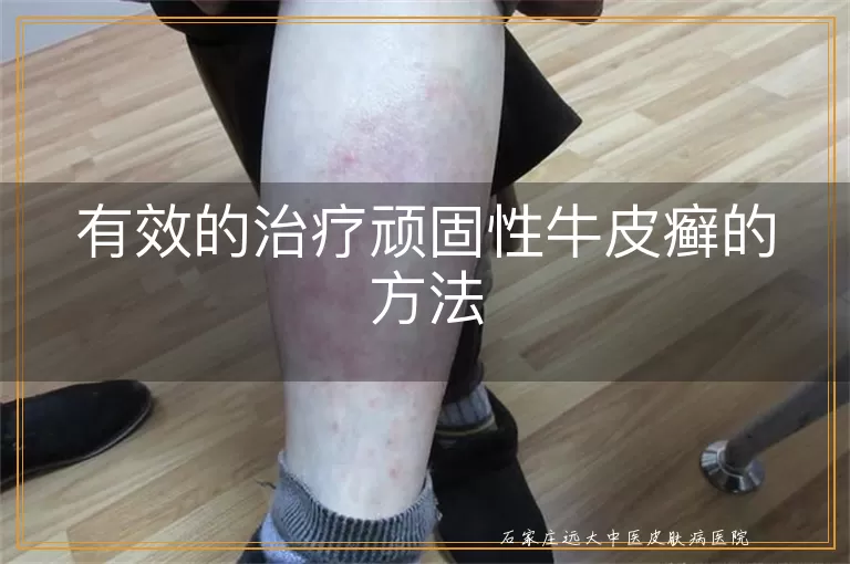 有效的治疗顽固性牛皮癣的方法