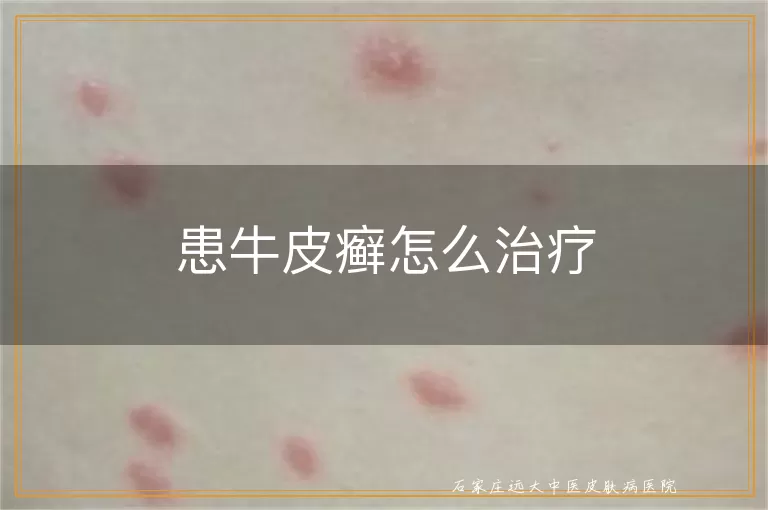患牛皮癣怎么治疗