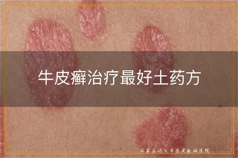 牛皮癣治疗最好土药方