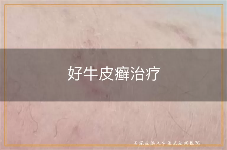 好牛皮癣治疗