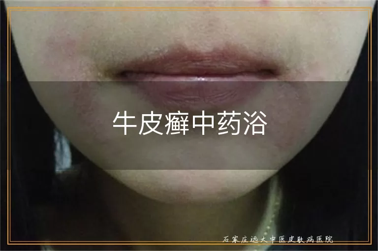 牛皮癣中药浴
