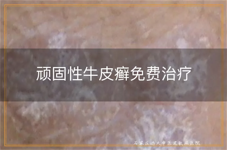 顽固性牛皮癣免费治疗
