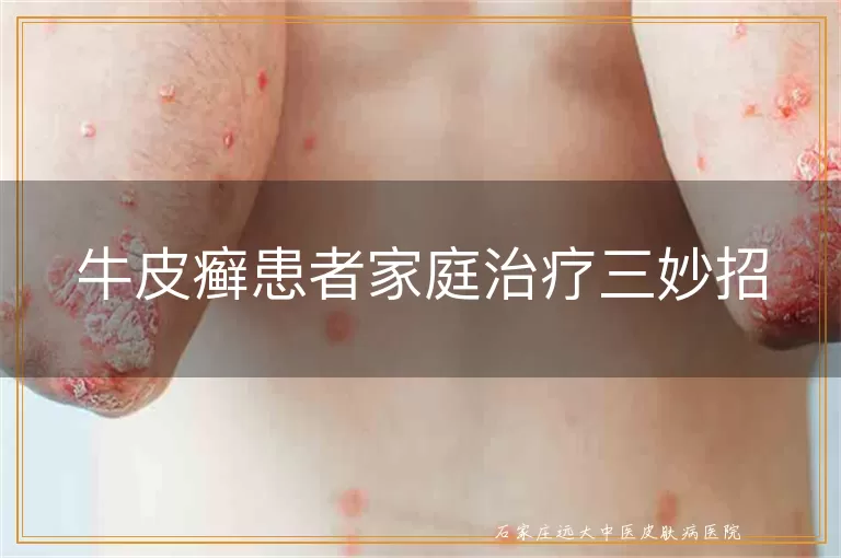 牛皮癣患者家庭治疗三妙招