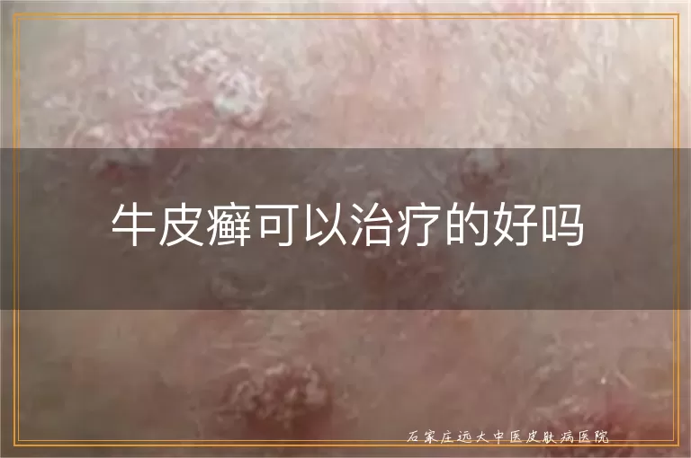 牛皮癣可以治疗的好吗