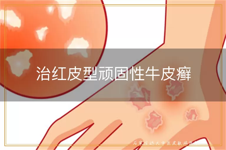 治红皮型顽固性牛皮癣