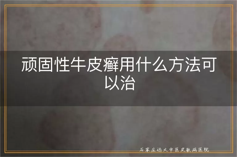 顽固性牛皮癣用什么方法可以治