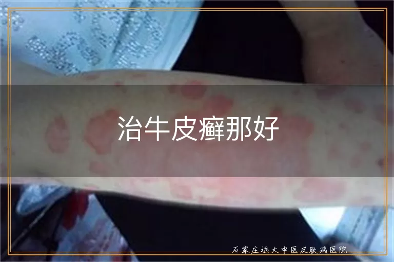 治牛皮癣那好
