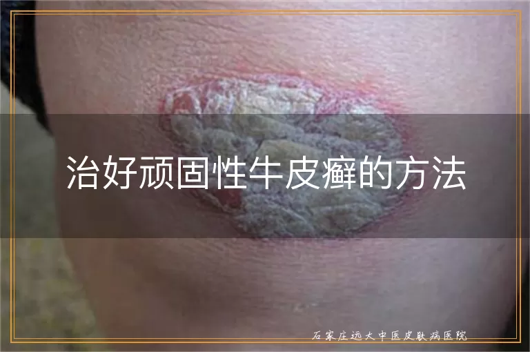 治好顽固性牛皮癣的方法