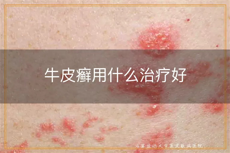 牛皮癣用什么治疗好