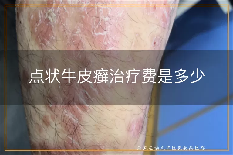 点状牛皮癣治疗费是多少