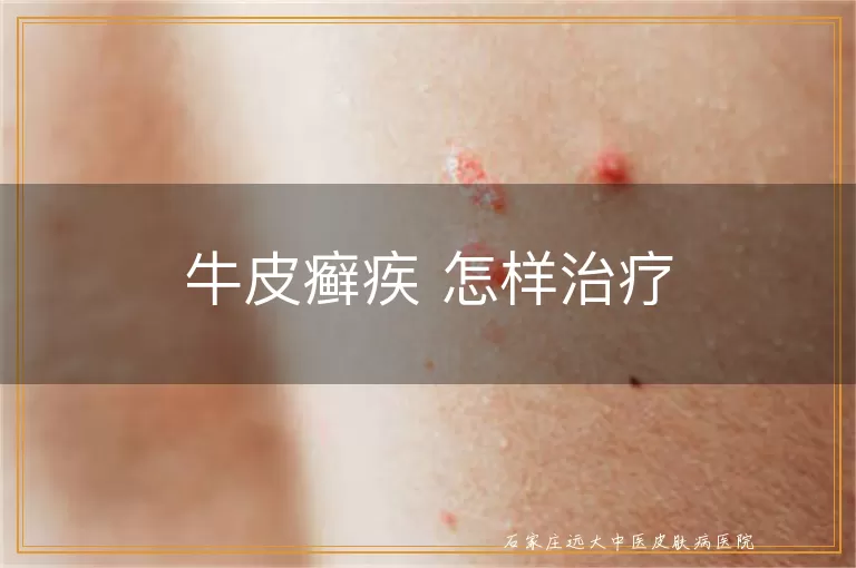 牛皮癣疾 怎样治疗