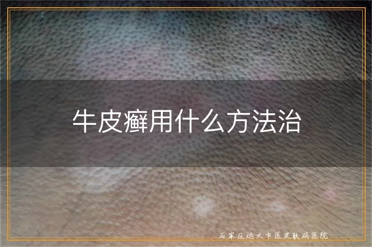 牛皮癣用什么方法治
