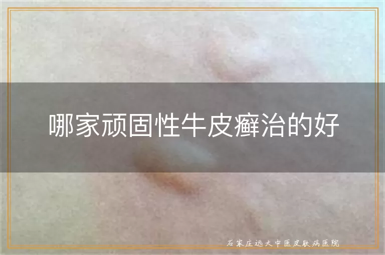 哪家顽固性牛皮癣治的好