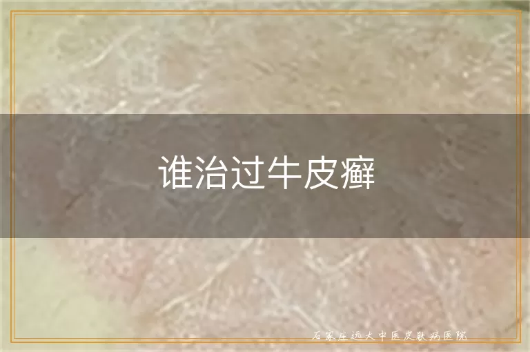 谁治过牛皮癣