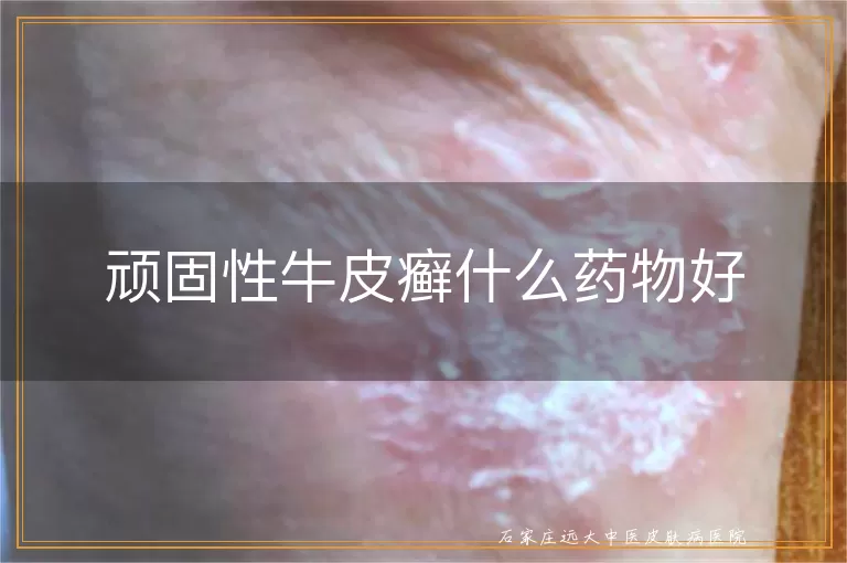顽固性牛皮癣什么药物好