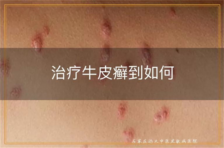 治疗牛皮癣到如何