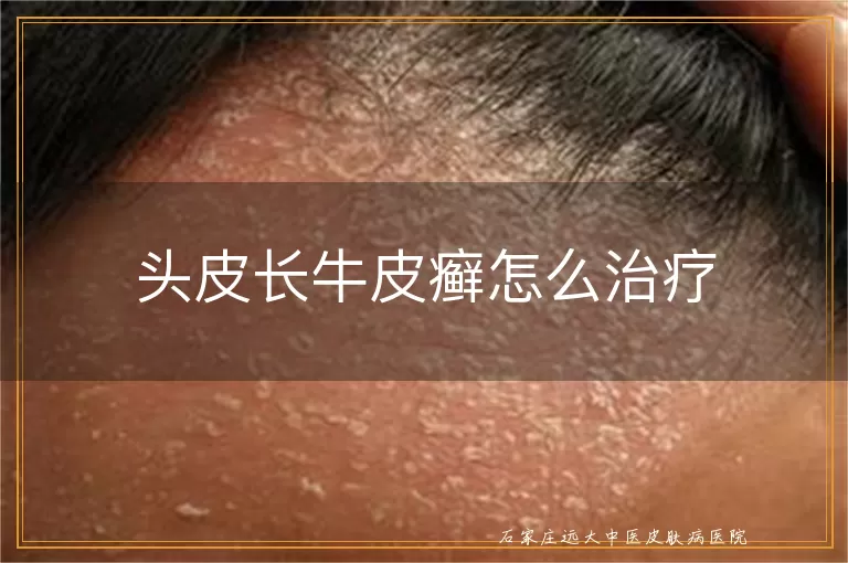 头皮长牛皮癣怎么治疗