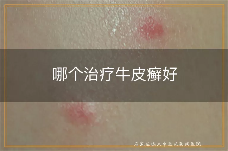 哪个治疗牛皮癣好