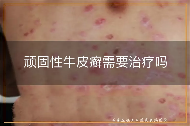 顽固性牛皮癣需要治疗吗