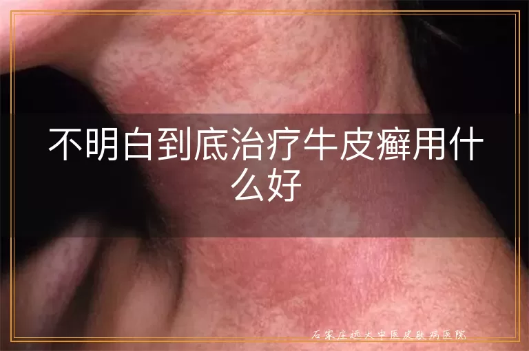 不明白到底治疗牛皮癣用什么好