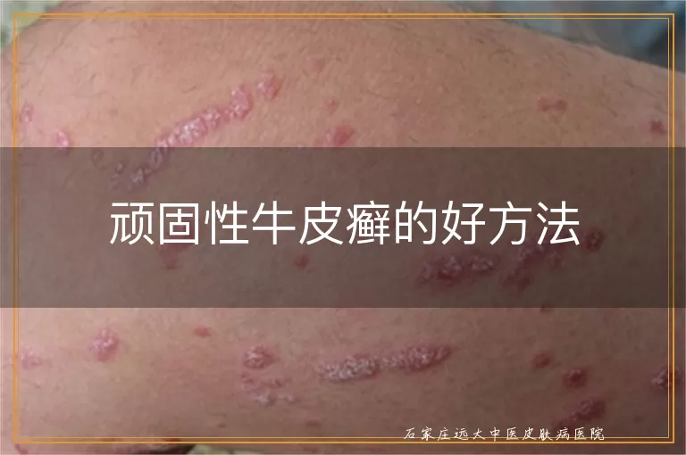 顽固性牛皮癣的好方法