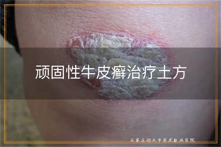 顽固性牛皮癣治疗土方