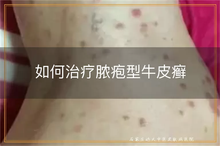 如何治疗脓疱型牛皮癣