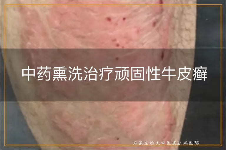 中药熏洗治疗顽固性牛皮癣