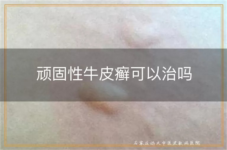 顽固性牛皮癣可以治吗