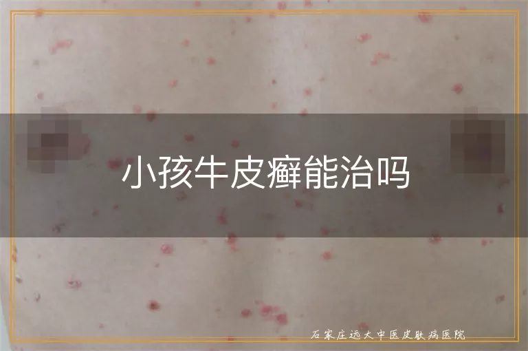 小孩牛皮癣能治吗
