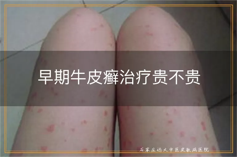 早期牛皮癣治疗贵不贵