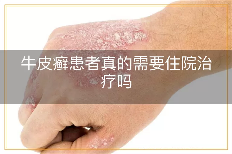 牛皮癣患者真的需要住院治疗吗