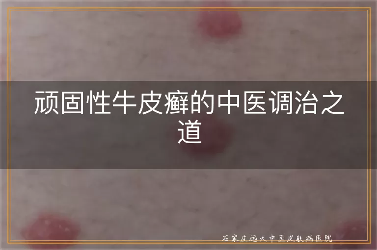 顽固性牛皮癣的中医调治之道