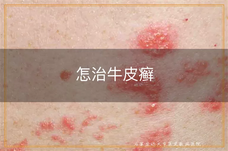 怎治牛皮癣