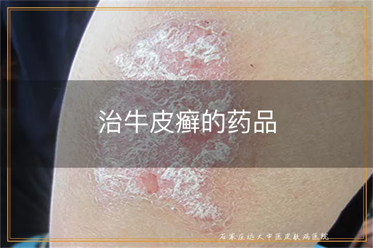 治牛皮癣的药品