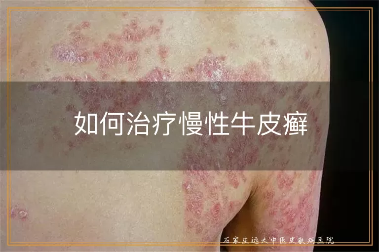 如何治疗慢性牛皮癣