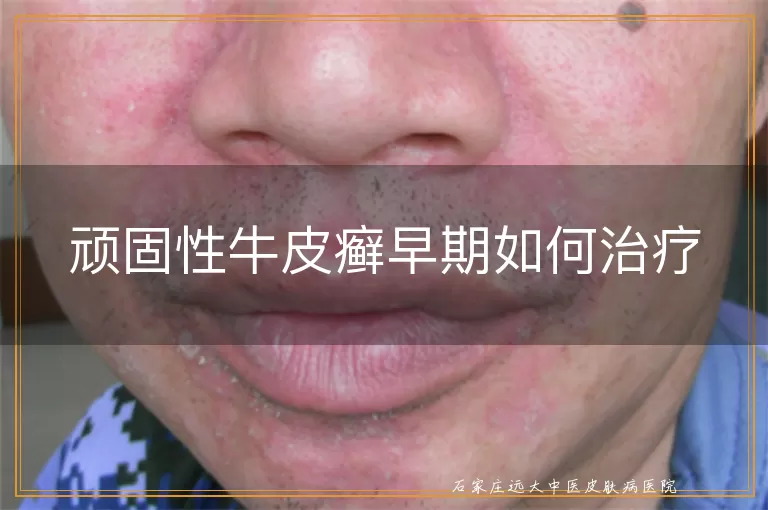 顽固性牛皮癣早期如何治疗